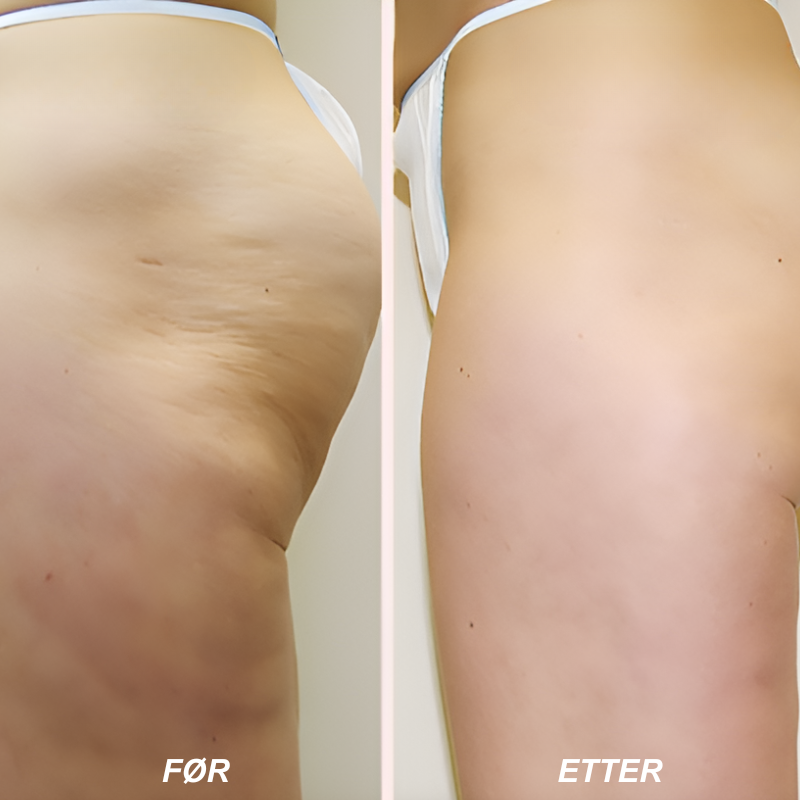 LegaLuxe™ | Rull bort cellulitter – avslør fastere, glattere hud
